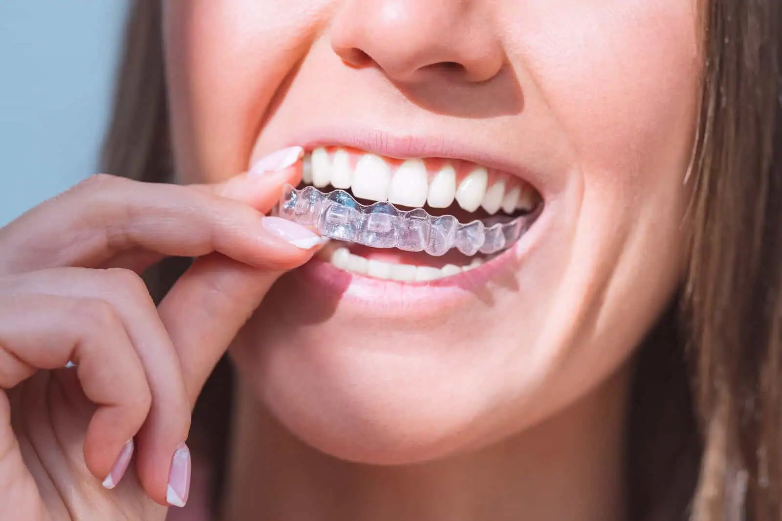 Invisalign Clear Aligners Colorado