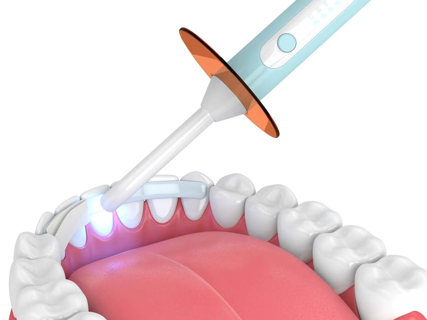 Composite resin being cured onto a tooth during a dental bonding treatment