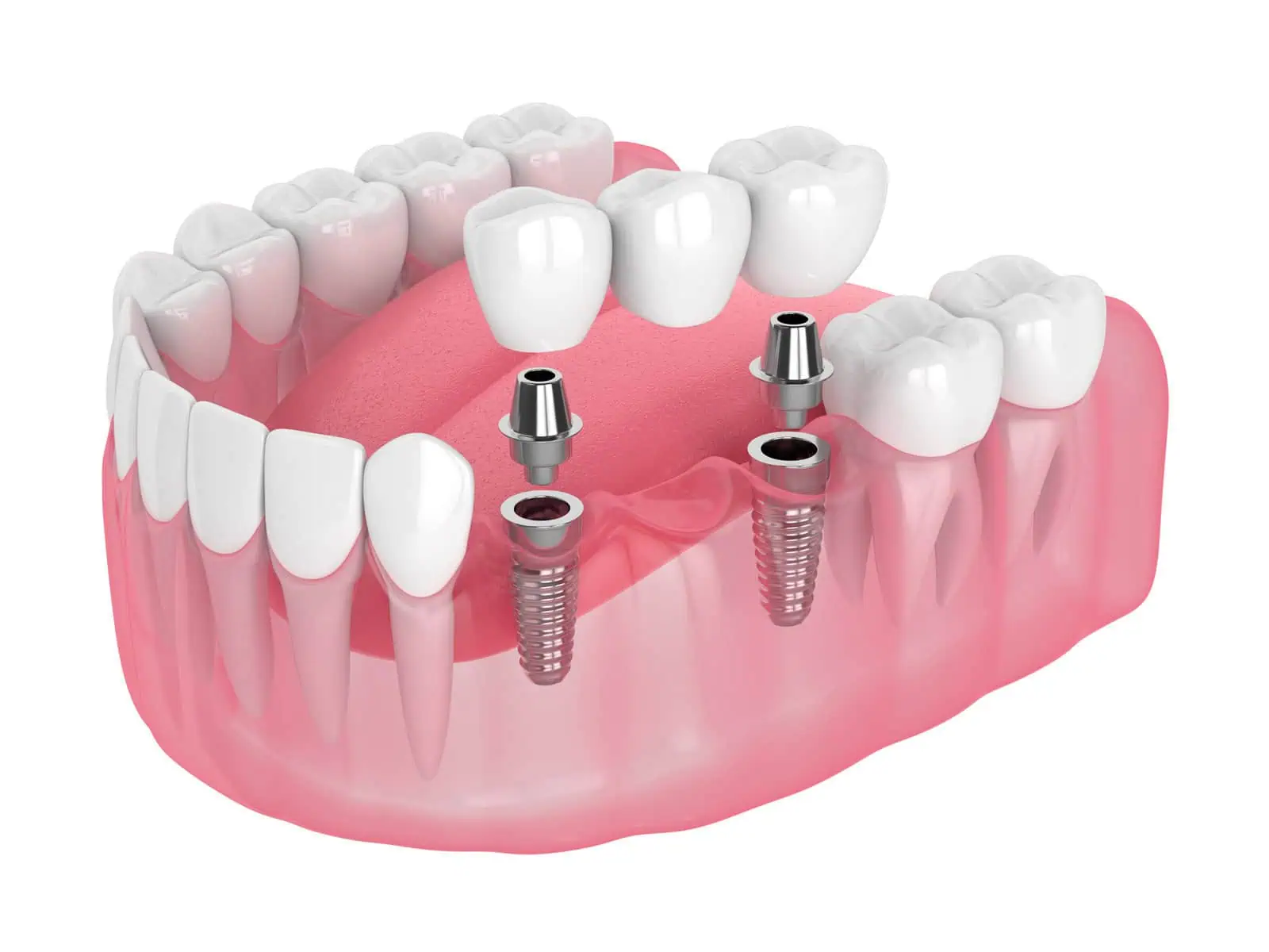 Implant-supported dentures in Golden, CO